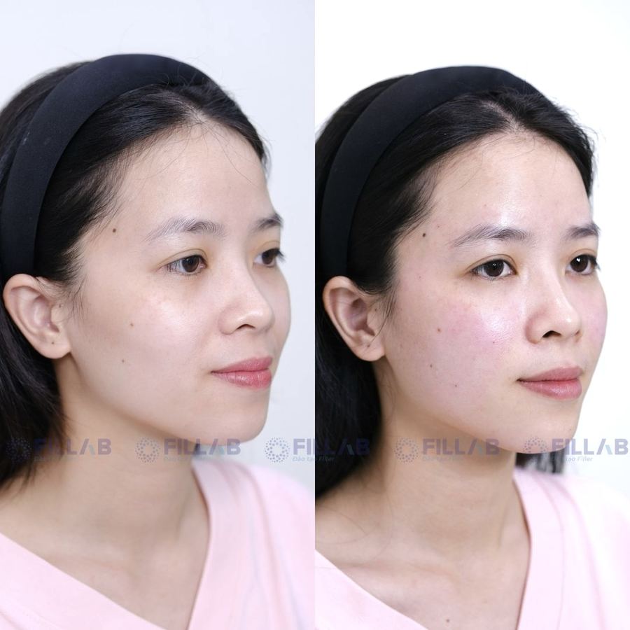 Ca before - after do học viên FILLAB thực hiện trong khoá Filler Chuyên Sâu